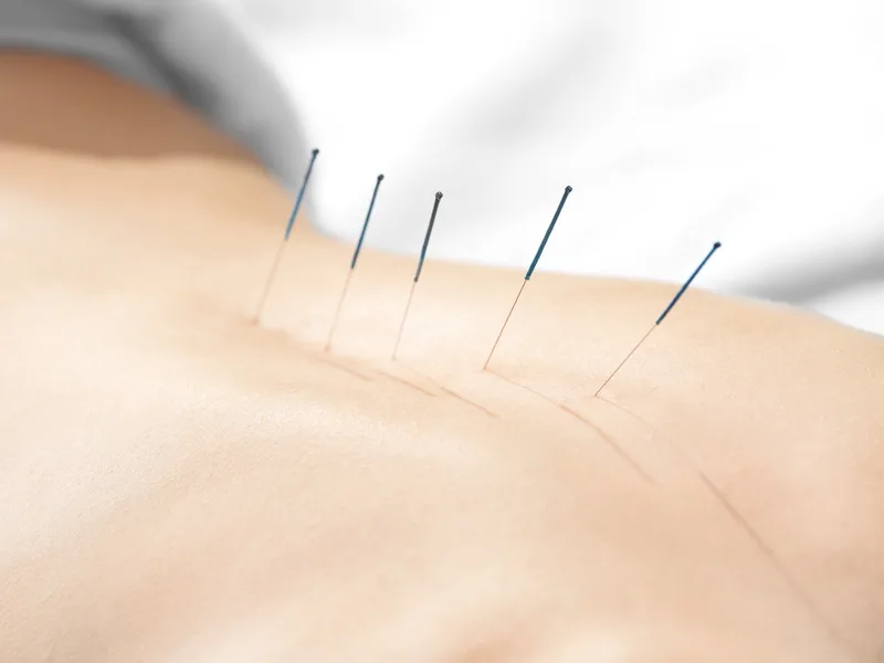 Acupuncture at Sovereign Light Chiropractic in Suwanee