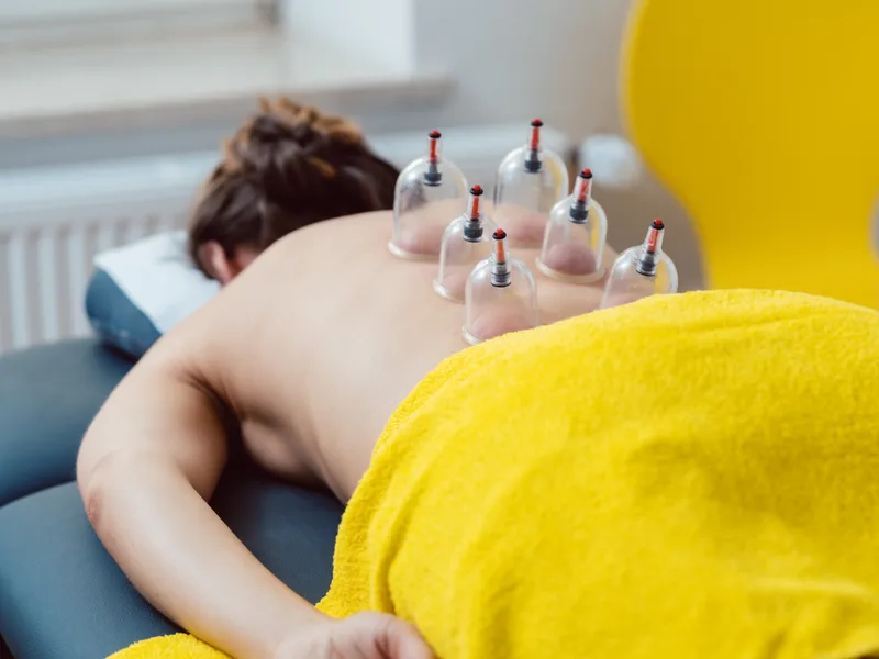 Cupping Therapy at Sovereign Light Chiropractic in Suwanee