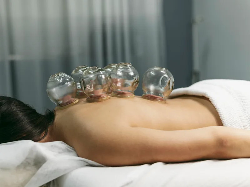 Cupping Therapy at Sovereign Light Chiropractic in Suwanee