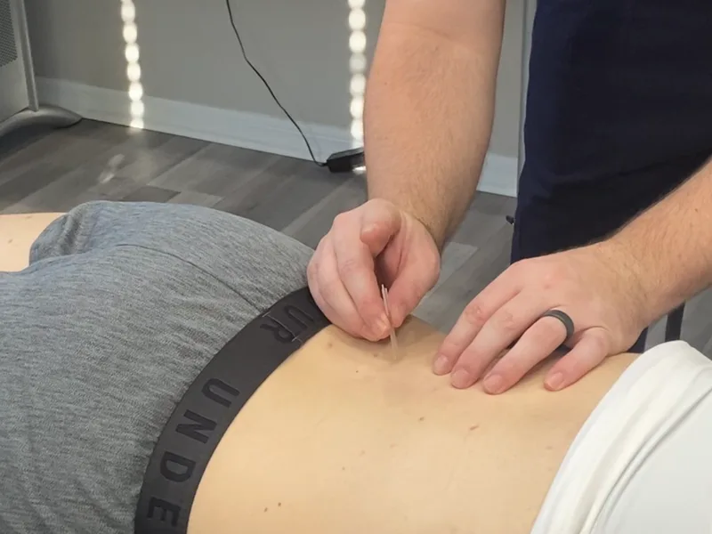 How Dry Needling works at Sovereign Light Chiropractic