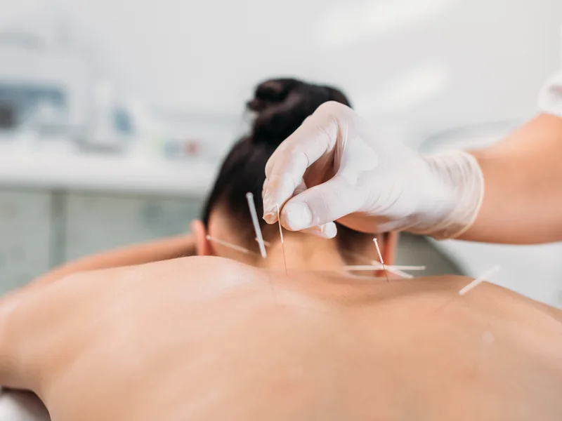 Dry Needling at Sovereign Light Chiropractic in Suwanee
